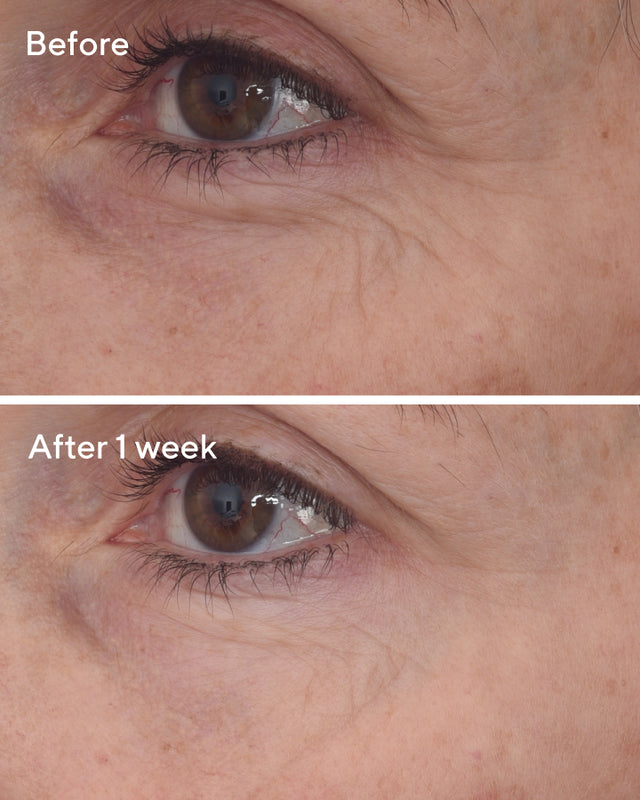 Retinal ReSculpt™ Eye Lift Treatment